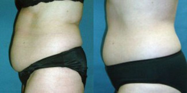 Before After Image 02